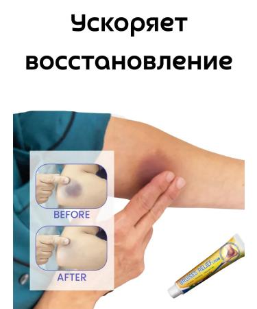 Remini cream ointment from bruises bruises and hematomas - Buy Online on GoSupps.com