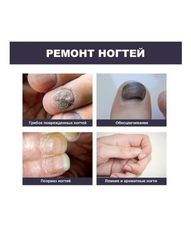 Ouhoe Restore damaged nails the essence to remove fungi - Buy Online on GoSupps.com