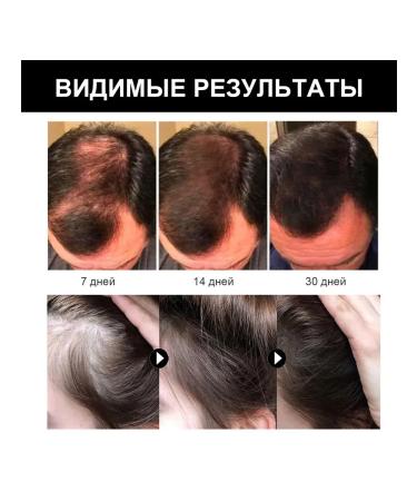 Ouhoe Promotes hair growth with essential oil prevent the fall - Buy Online on GoSupps.com