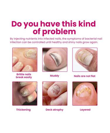 OUHOE Ginger Care for nails Essence - Buy Online on GoSupps.com