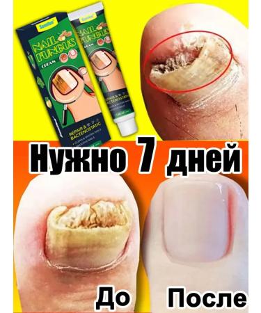 Ointment from nail fungus on the legs 30 g