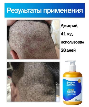 LYDIMOON Significant shampoo against dandruff 300 ml - Buy Online on GoSupps.com