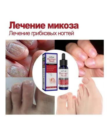 eelhoe moisturizes the restoration of nails to suppress fungi liquid - Buy Online on GoSupps.com