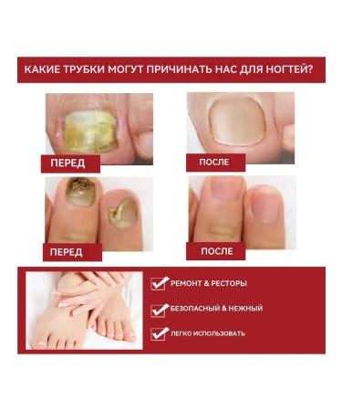 eelhoe moisturizes the restoration of nails to suppress fungi liquid - Buy Online on GoSupps.com