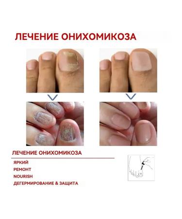 eelhoe moisturizes the restoration of nails to suppress fungi liquid - Buy Online on GoSupps.com