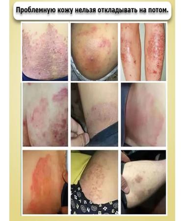 Ointment from psoriasis from eczema from dermatystabystro and effectively - Buy Online on GoSupps.com