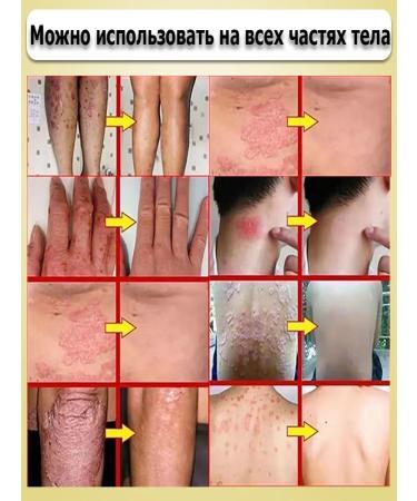 Ointment from psoriasis from eczema from dermatystabystro and effectively - Buy Online on GoSupps.com
