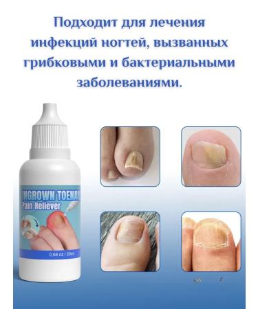 Antibacterial fluid for the treatment of ingrown nails 5 pcs - Buy Online on GoSupps.com