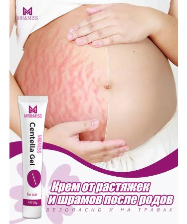 Cream from stretch marks and scars after giving birth 20 g