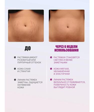 Cream from stretch marks and scars after giving birth 20 g - Buy Online on GoSupps.com