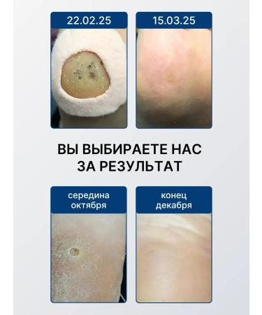 Cream from warts and papilloma spirularin vs Creme 10 ml - Buy Online on GoSupps.com