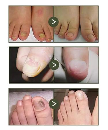 Chinese ointment from nail fungus - Buy Online on GoSupps.com
