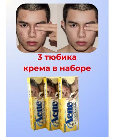 Ailuu Acne cream on the face and body - Buy Online on GoSupps.com