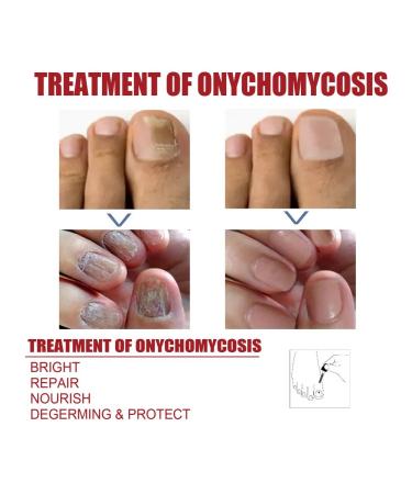 Eelhoe fluid for restoration of nails fast action - Buy Online on GoSupps.com