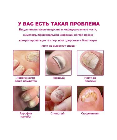ginger fungus of nails repair essence prevent a fracture - Buy Online on GoSupps.com