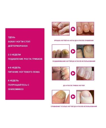 ginger fungus of nails repair essence prevent a fracture - Buy Online on GoSupps.com