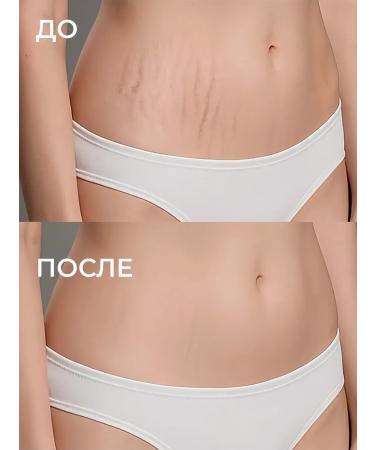 DRSKINVITA Get rid of stretch marks - Buy Online on GoSupps.com
