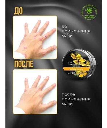 Caucasian Pharmacy Set of ointment from psoriasis for hands and body 3pcs - Buy Online on GoSupps.com