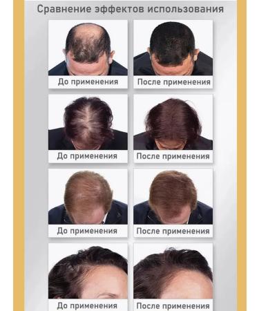 LYDIMOON Anti-hair loss anti-dandruff and hair growth shampoo - Buy Online on GoSupps.com