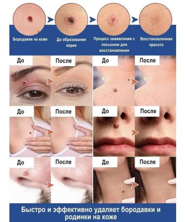 Cream for removing warts 20 ml - Buy Online on GoSupps.com