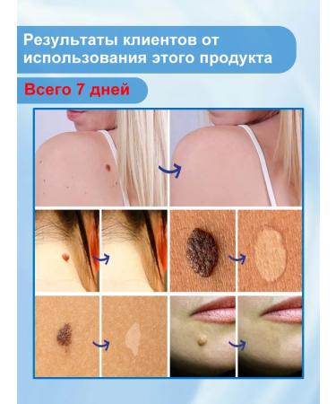 Cream for removing warts 20 ml - Buy Online on GoSupps.com