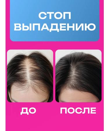 lvcos Hair tonic for growth from loss