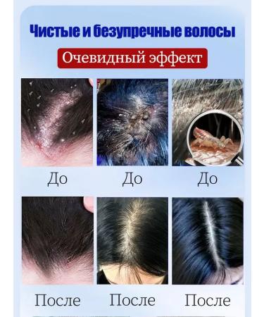 DRSKINVITA Shampoo against dandruff with selenium disulfide 300 ml - Buy Online on GoSupps.com