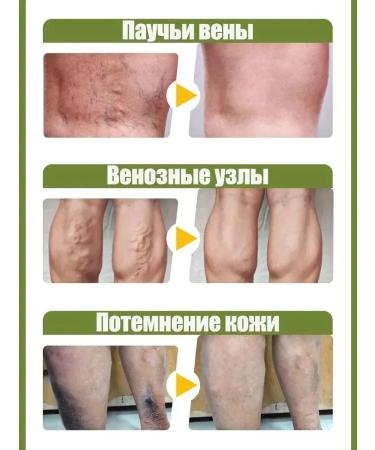 Cream from varicose veins 20g relieves pain and swelling - Buy Online on GoSupps.com