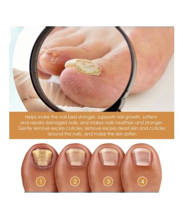 Eelhoe treatment of nail fungus gel for care for the horn layer - Buy Online on GoSupps.com