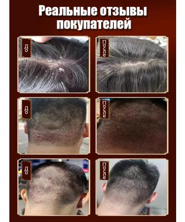 LYDIMOON Anti-dandruff shampoo relieves itching prevents seborrheic dermatitis - Buy Online on GoSupps.com