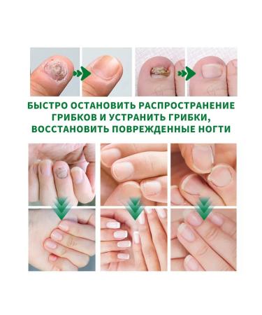 JaySuing Ginger care of nails with a solution of fungal infections - Buy Online on GoSupps.com