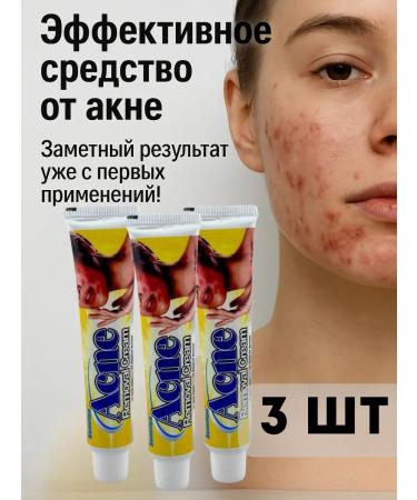 COME 3 Acne cream and acne on the face