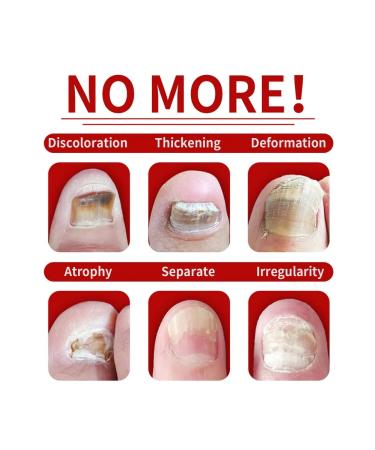 Jaysuing treatment of nail fungus tool for nail care - Buy Online on GoSupps.com