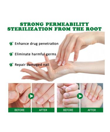 Jaysuing treatment of nail fungus tool for nail care - Buy Online on GoSupps.com