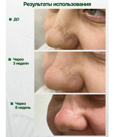 Marienkafer Swear cream from scars and scars - Buy Online on GoSupps.com