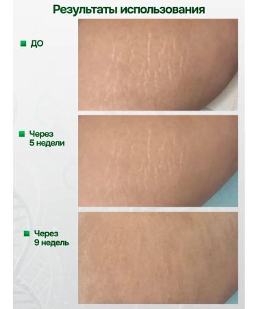 Marienkafer Swear cream from scars and scars - Buy Online on GoSupps.com