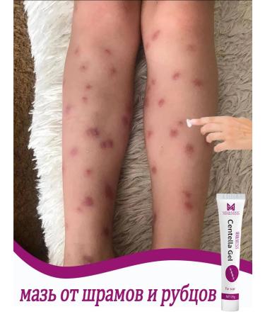 Cream from scars and traces of post -acne