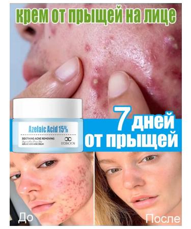 LYDIMOON Facial cream for acne with salicylic acid 30g