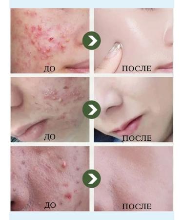 LYDIMOON Acne cream with azelainic acid 30 g - Buy Online on GoSupps.com