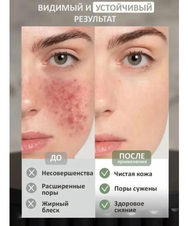 LYDIMOON Acne cream with azelainic acid 30 g - Buy Online on GoSupps.com