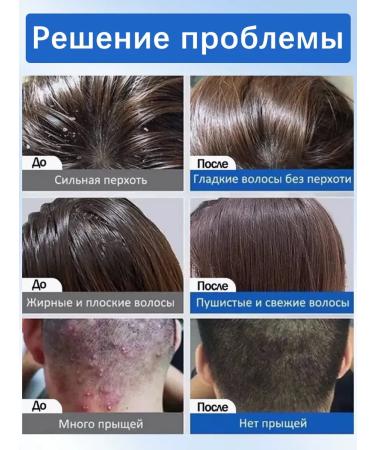 Shampoo against dandruff with selenium disulfide - Buy Online on GoSupps.com