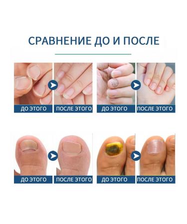 Slateers for nail care improvement - Buy Online on GoSupps.com