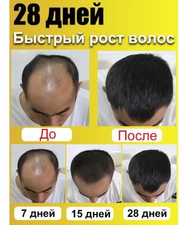 LYDIMOON Hair growth shampoo and 200ml loss - Buy Online on GoSupps.com