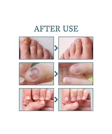 Ximonth nail fungus Care - Buy Online on GoSupps.com