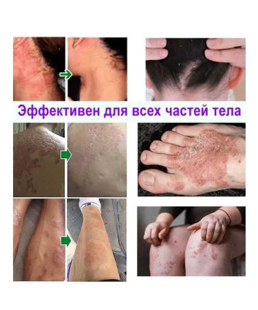 DRSKINVITA Chinese miracle cream from psoriasis and dermatitis - Buy Online on GoSupps.com