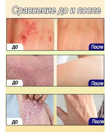 DRSKINVITA Chinese miracle cream from psoriasis and dermatitis - Buy Online on GoSupps.com