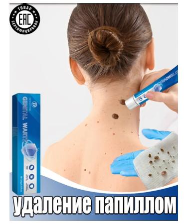 Cream for quick removal of papillomas and warts