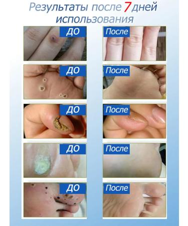 Cream for quick removal of papillomas and warts - Buy Online on GoSupps.com