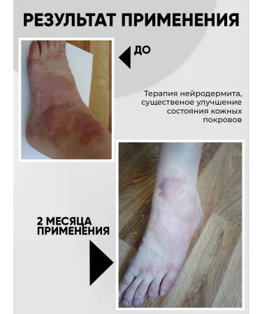 Acrustal Ointment from psoriasis and eczema with Naftalan 165 ml - Buy Online on GoSupps.com