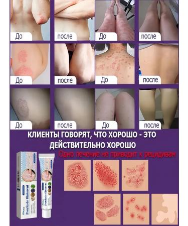 DRSKINVITA Skin care cream from psoriasis 20 g - Buy Online on GoSupps.com